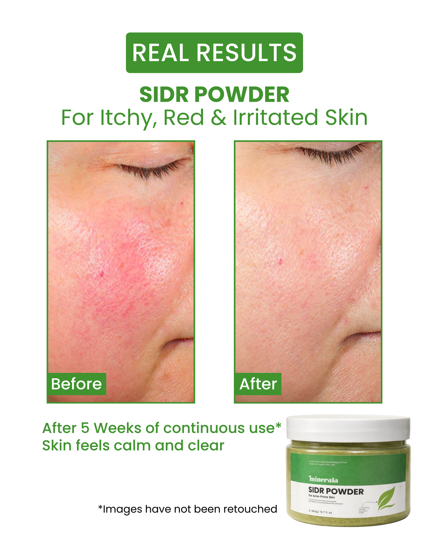Sidr Powder (External Acne Cleanse Mask)